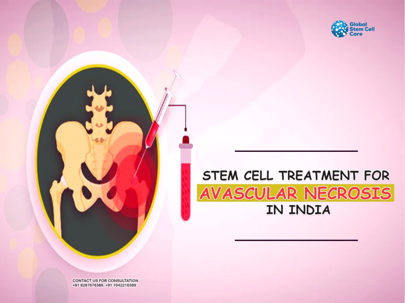 Can We Trust Stem Cell Treatment for Avascular Necrosis in India?