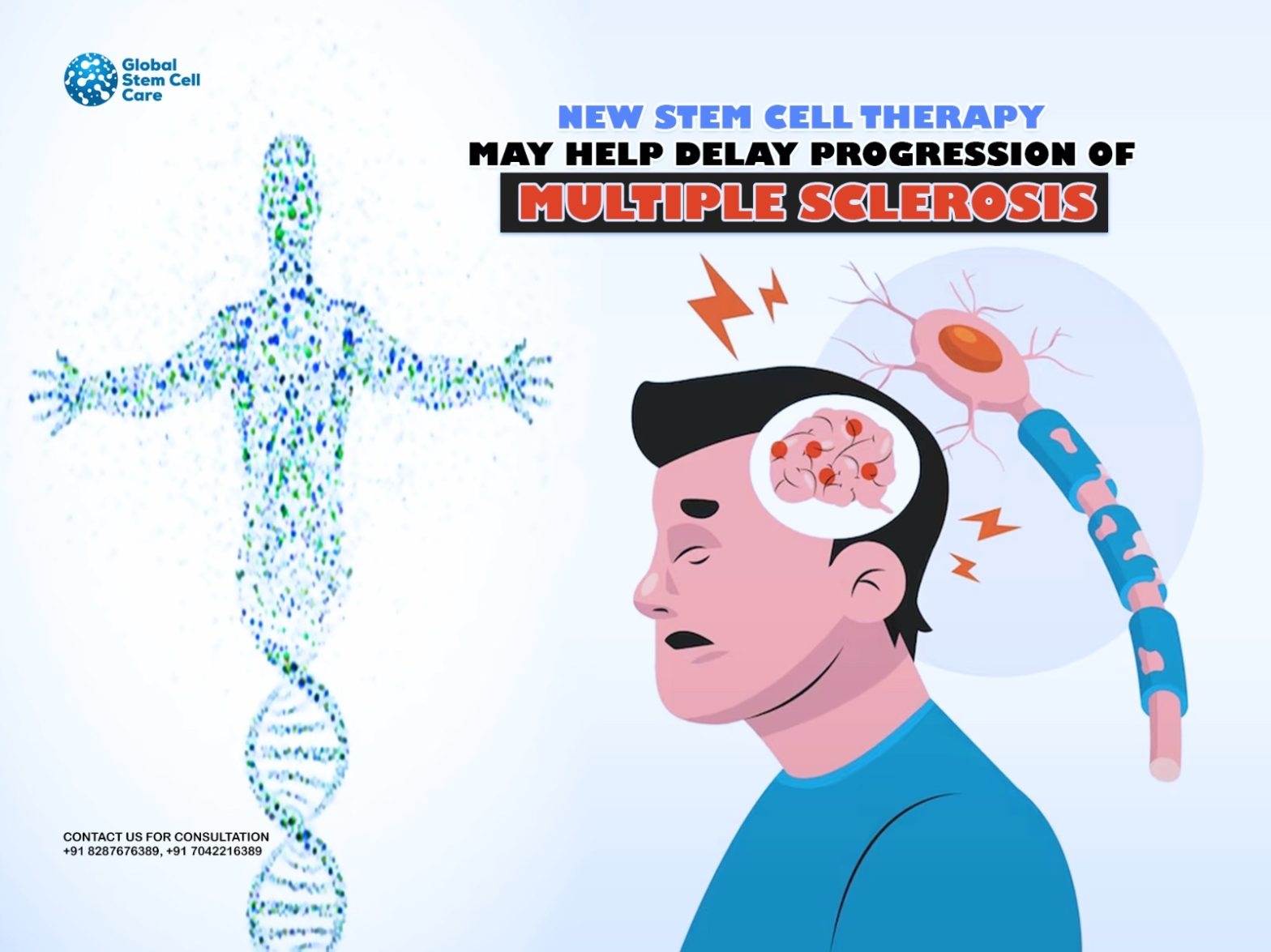New Stem Cell Therapy May Help Delay Progression of Multiple Sclerosis