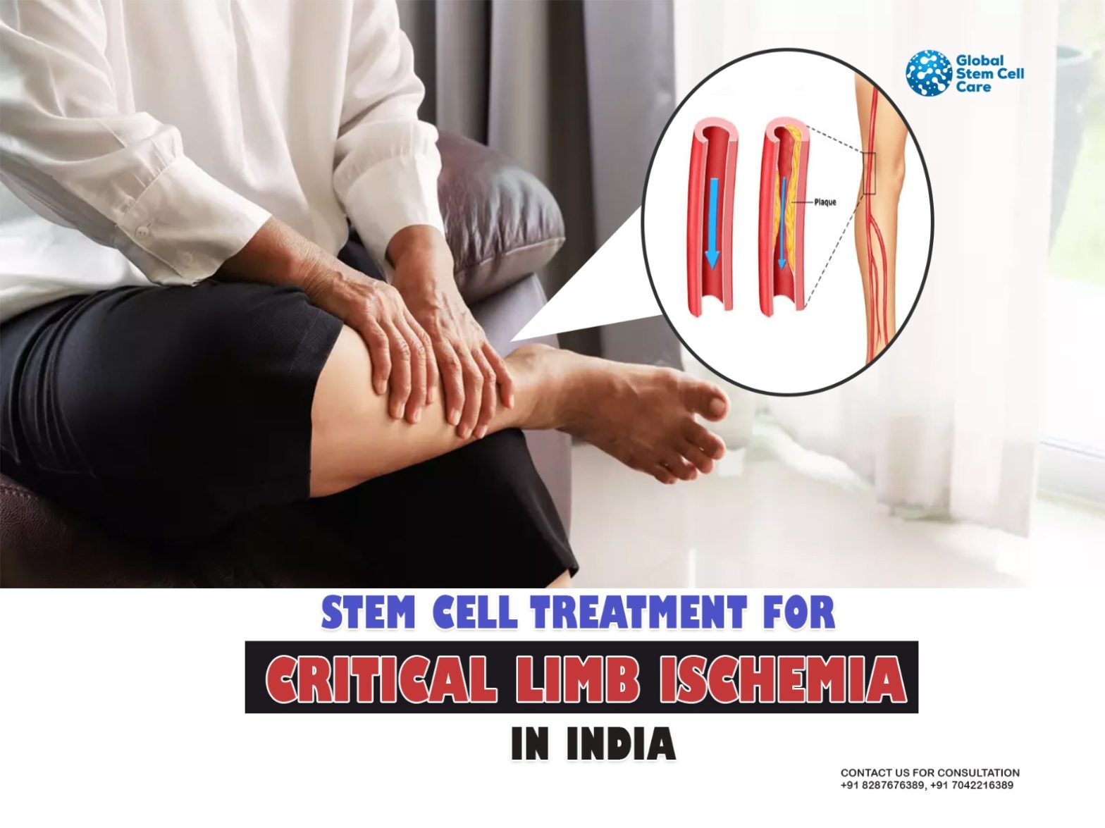 What Is the Important Procedure in Stem Cell Treatment for CLI?
