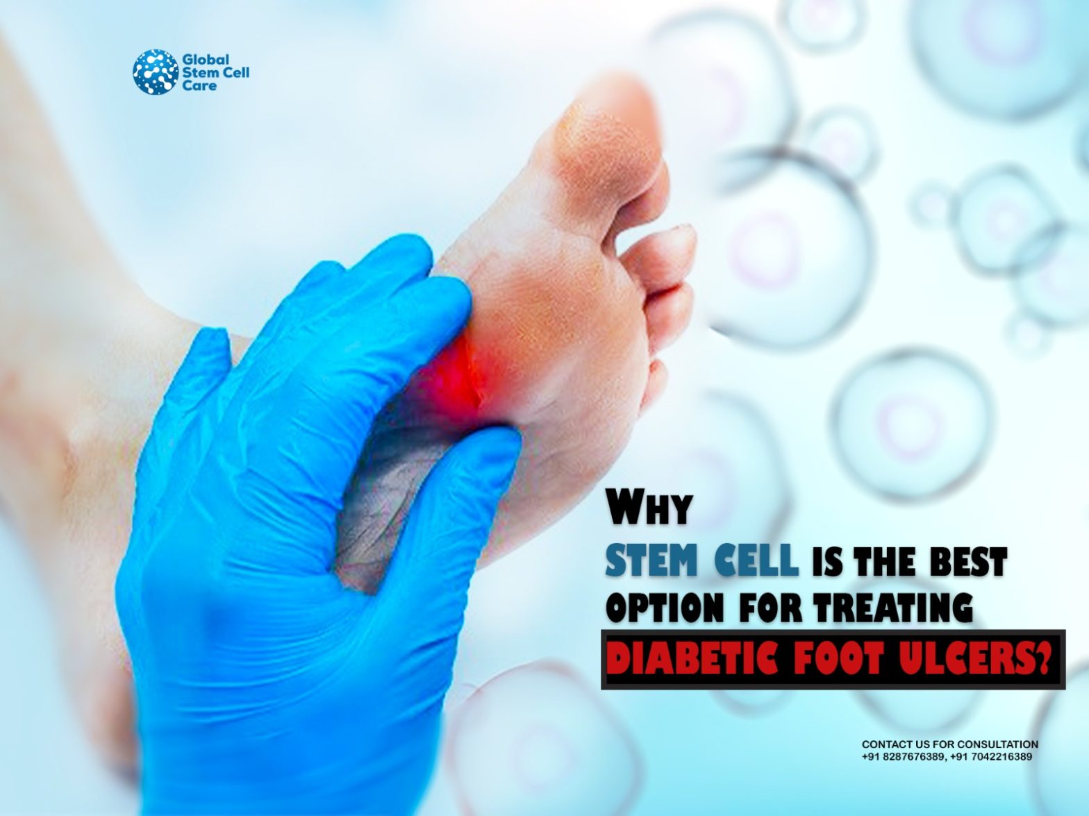 Why Stem Cell Is the Best Option for Treating Diabetic Foot Ulcers?