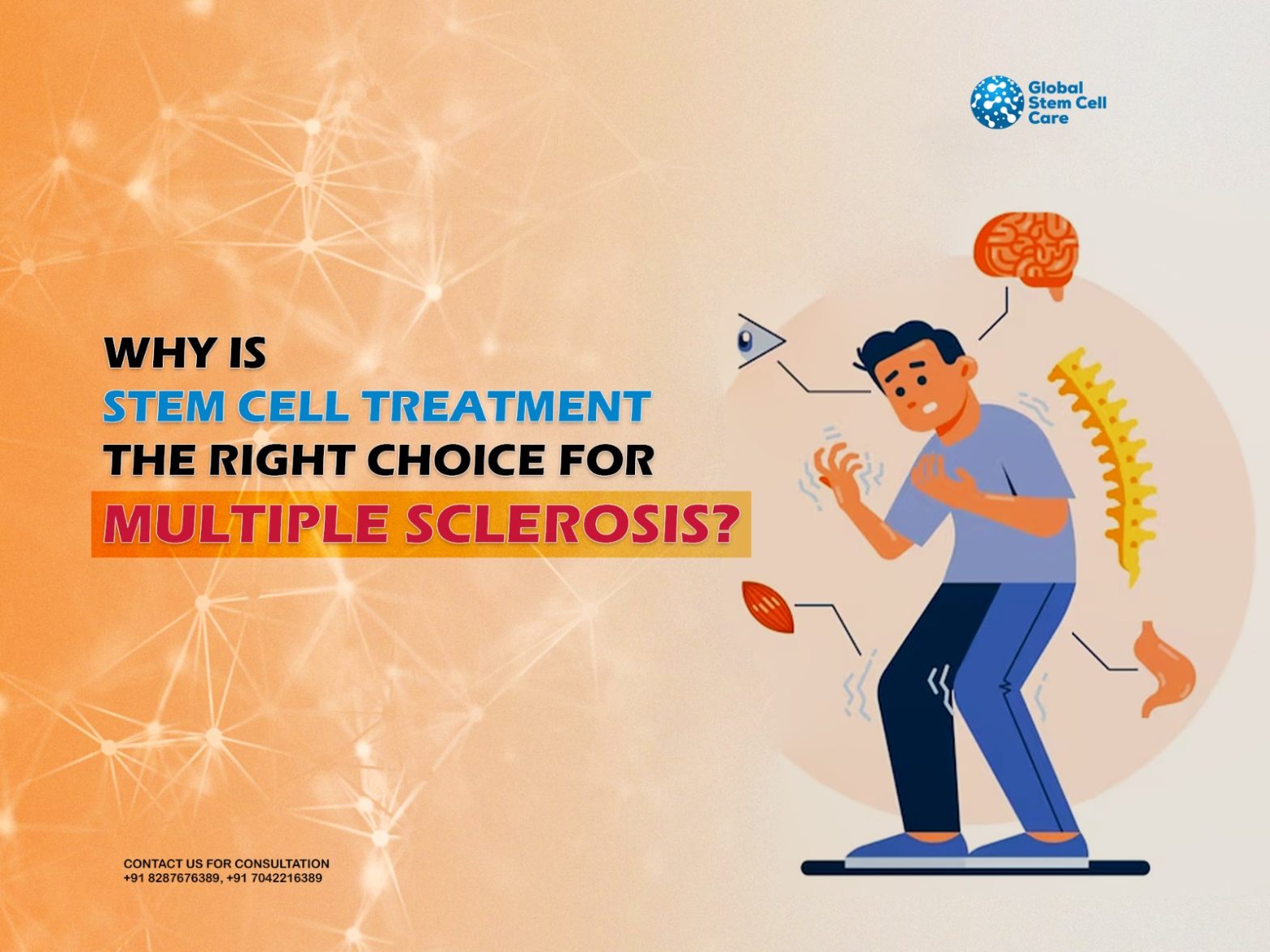 Why Is Stem Cell Treatment the Right Choice for Multiple Sclerosis?