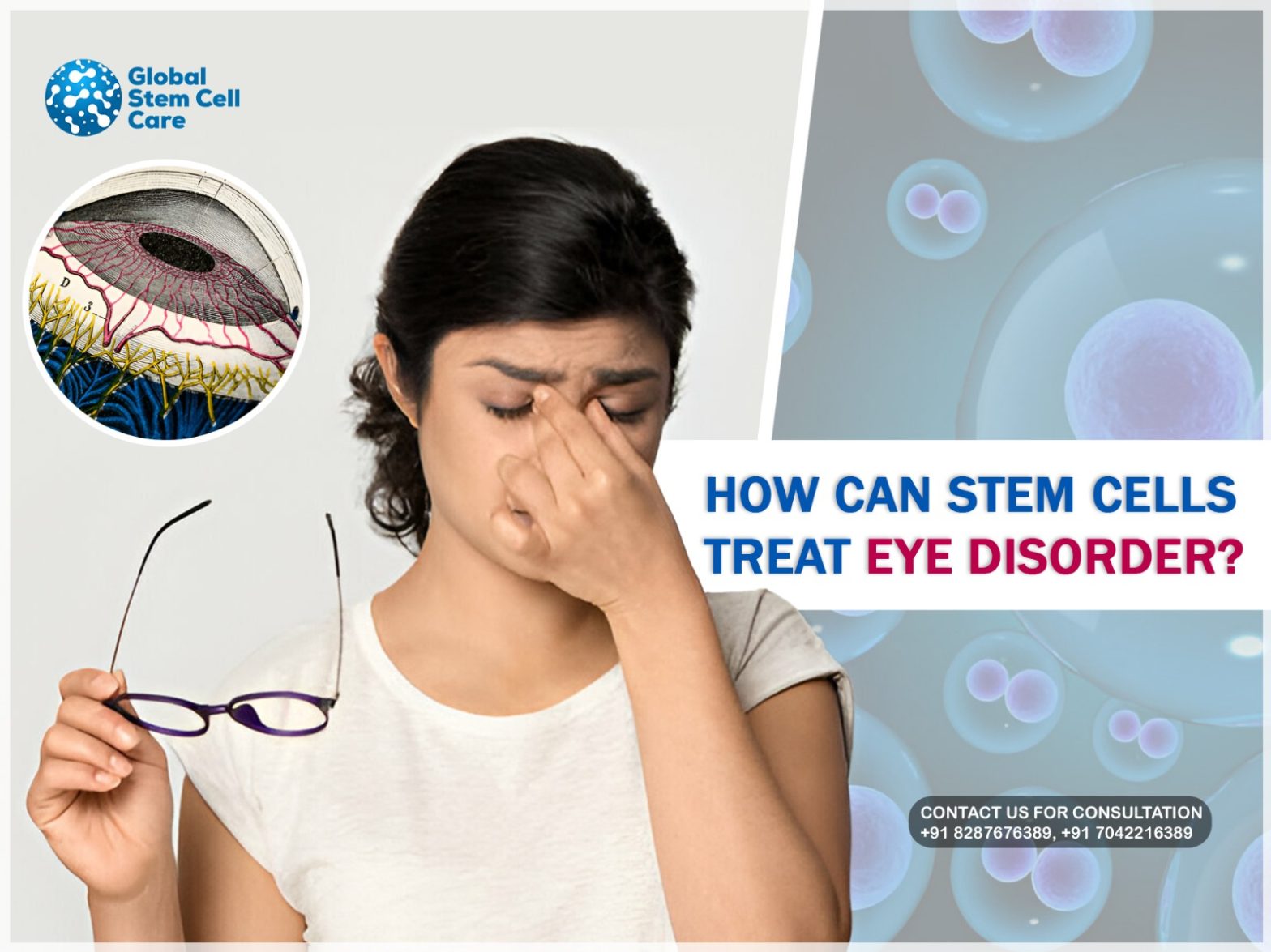 How Can Stem Cells Treat Eye Disorders?