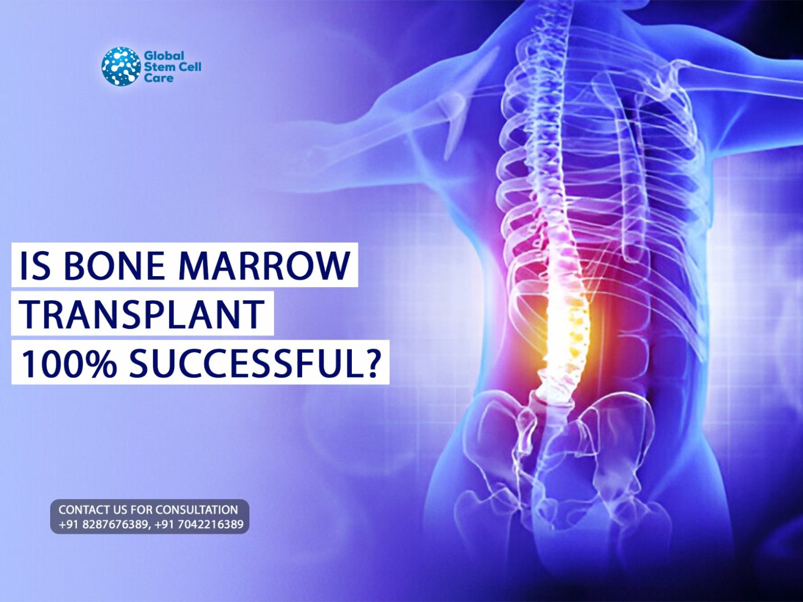Is Bone Marrow Transplant 100% Successful?