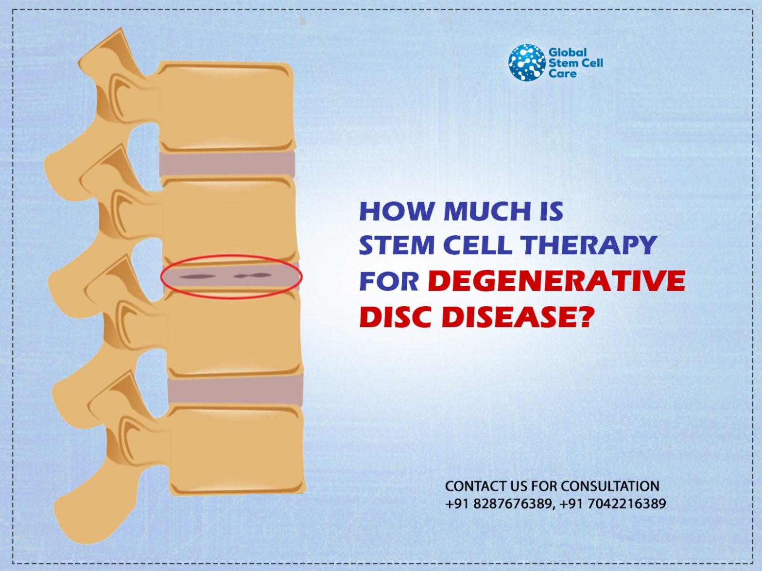 How Much Is Stem Cell Therapy for Degenerative Disc Disease?