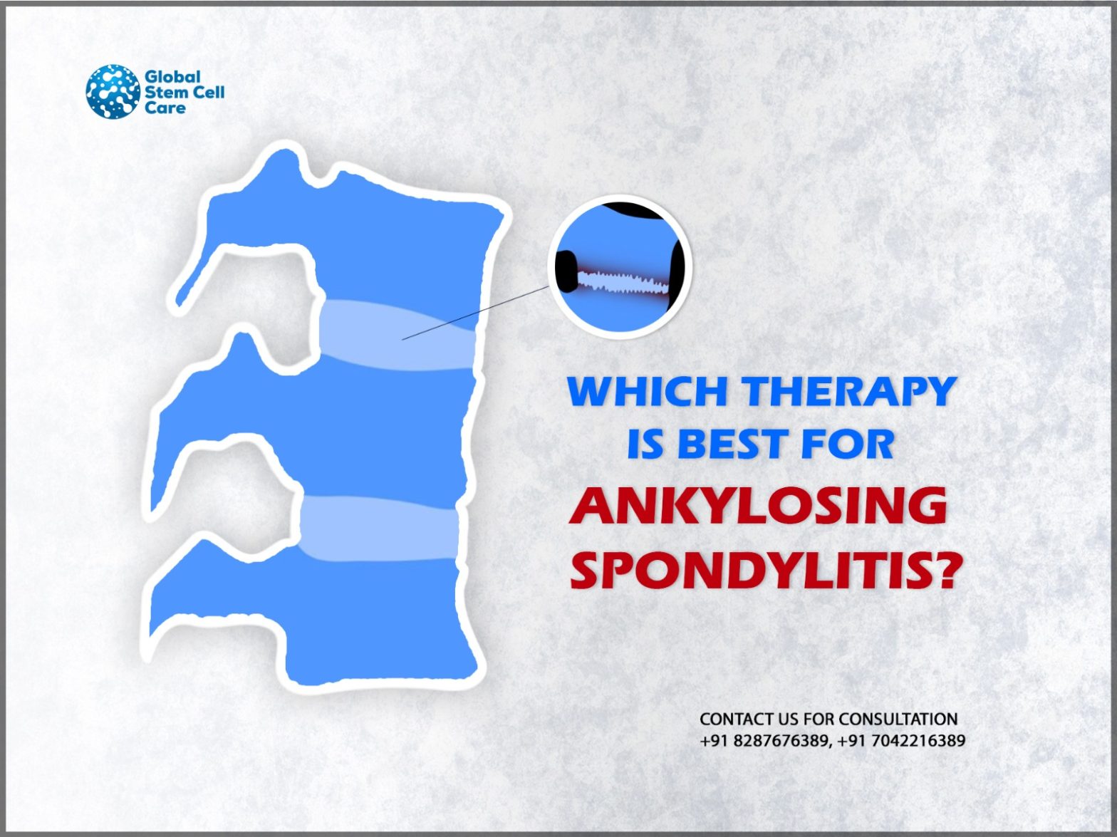 Which Therapy Is Best for Ankylosing Spondylitis?