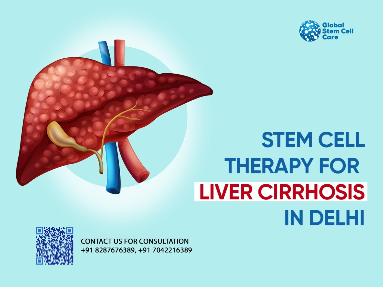 Stem Cell Therapy for Liver Cirrhosis in Delhi