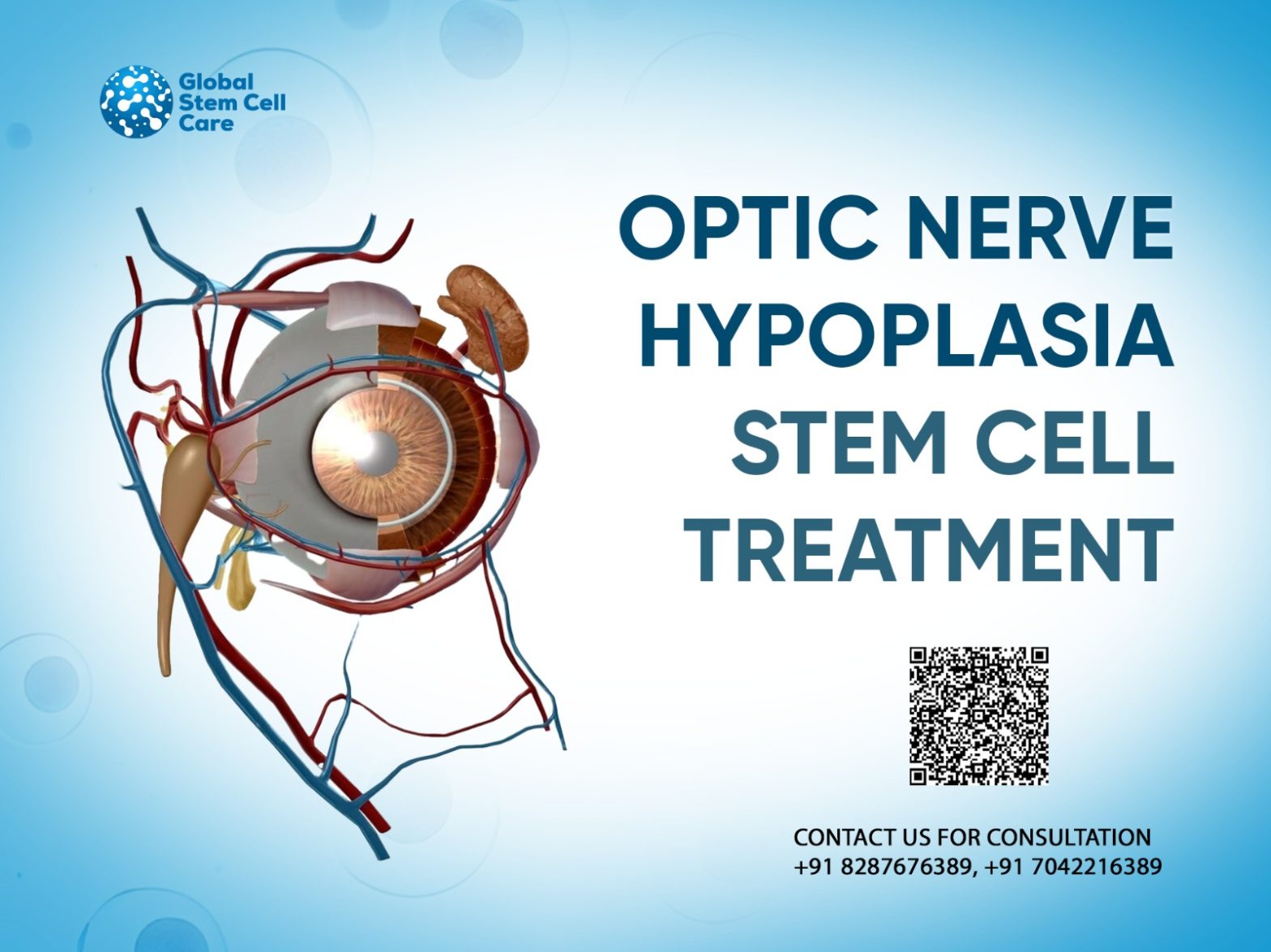 Optic Nerve Hypoplasia Stem Cell Treatment