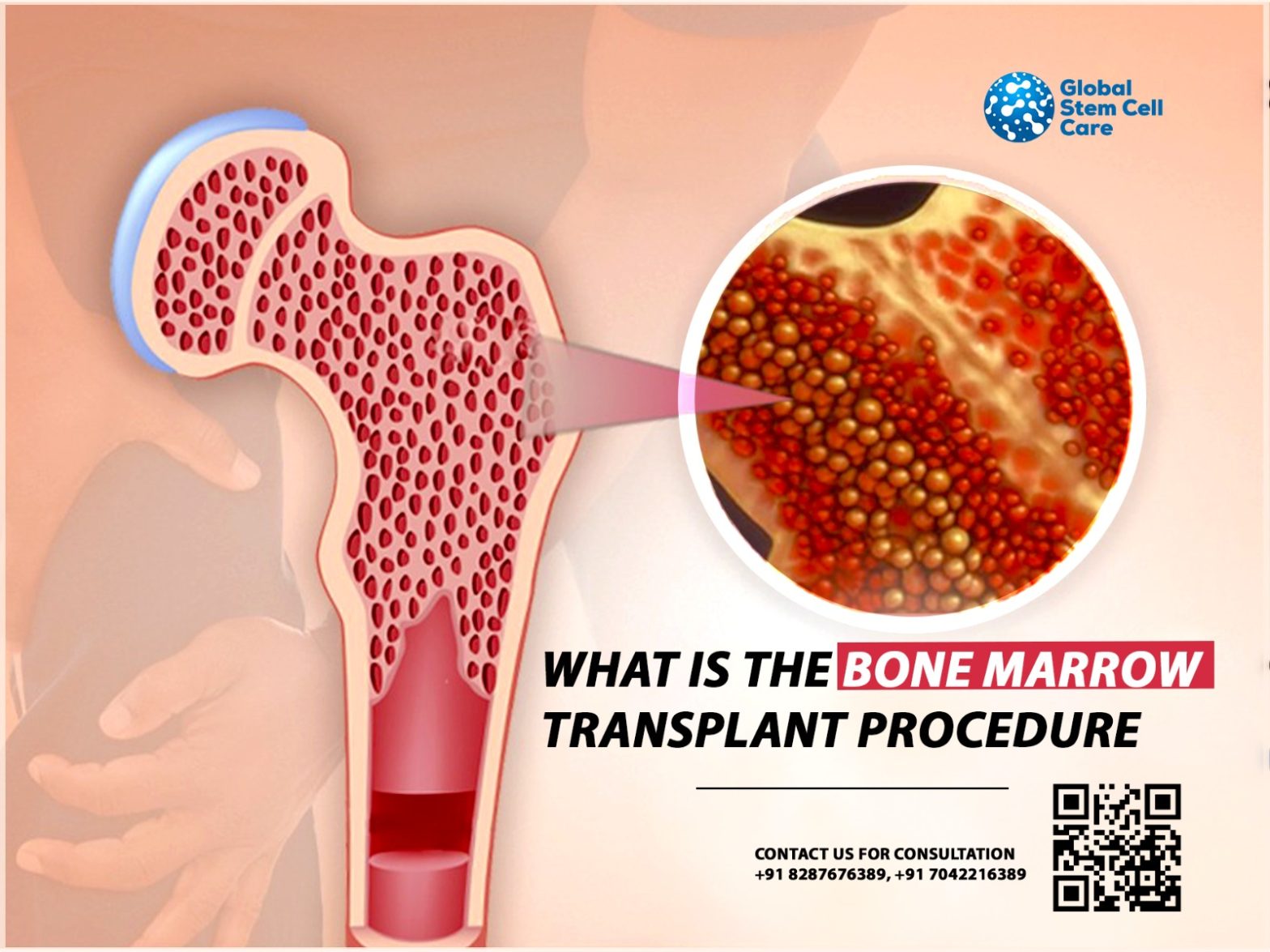 What Is the Bone Marrow Transplant Procedure?